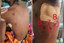 मौत के दरवाजे से लौटा युवक..17 चाकू वार…फटा फेफड़ा…कटी आंत…और सिम्स ने दी नई जिंदगी