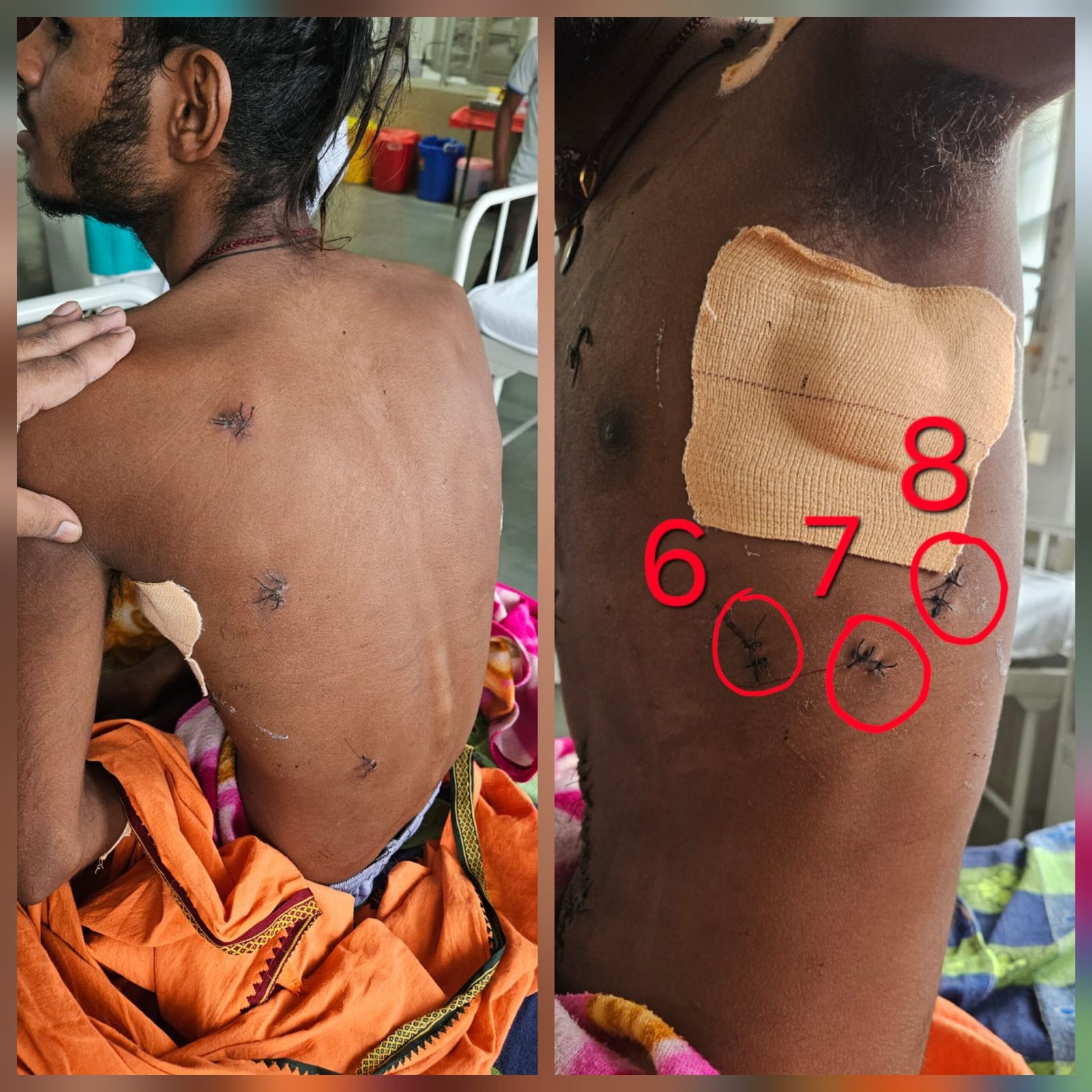 मौत के दरवाजे से लौटा युवक..17 चाकू वार…फटा फेफड़ा…कटी आंत…और सिम्स ने दी नई जिंदगी